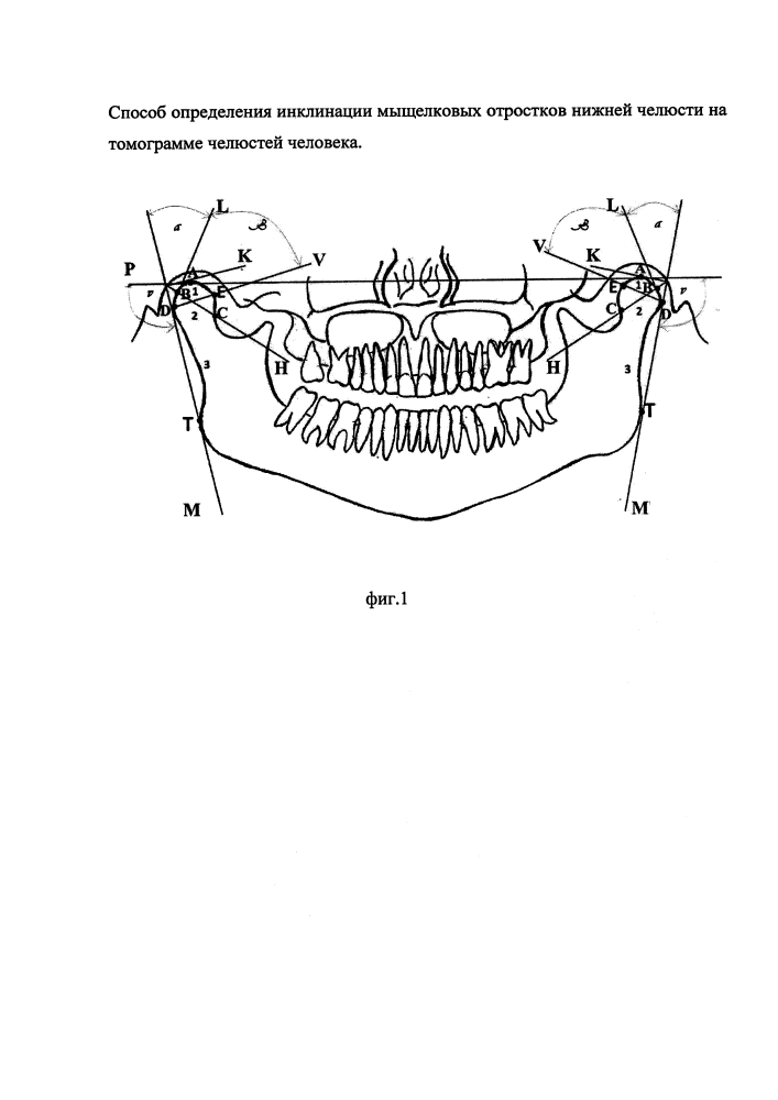 Метод определения инклинации мыщелкового отростка нижней челюсти на томограммах челюстей (патент 2633330)