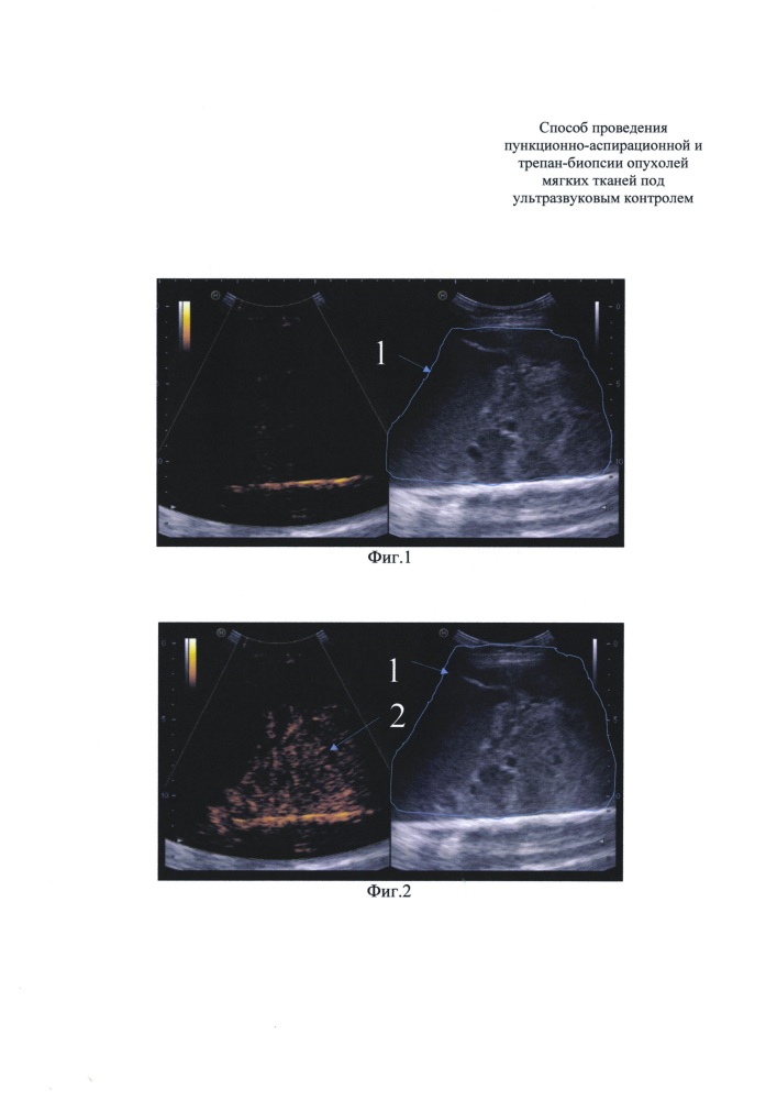 Способ проведения пункционно-аспирационной и трепан-биопсии опухолей мягких тканей под ультразвуковым контролем (патент 2662647)