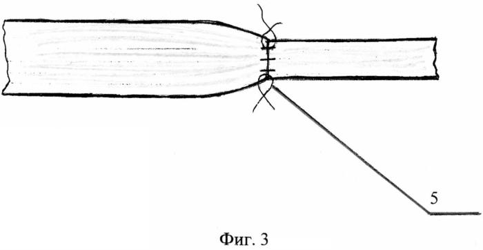 Способ сшивания концов нерва (патент 2572752)