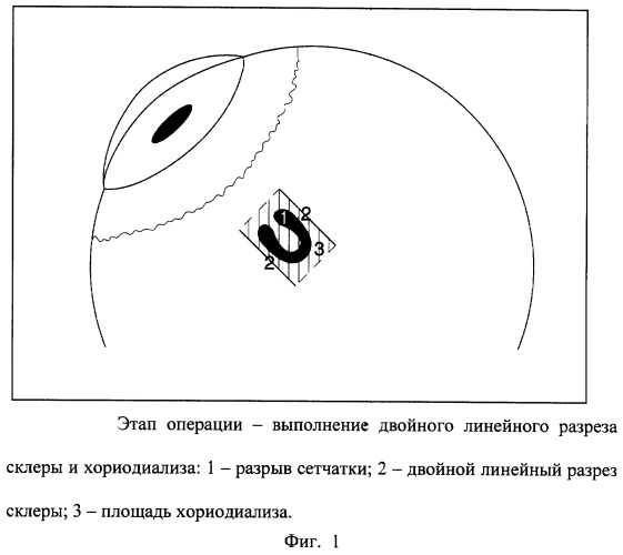 Способ лечения регматогенной отслойки сетчатки (патент 2244530)