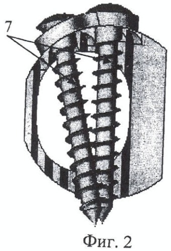 Фиксатор позвоночника (патент 2362517)