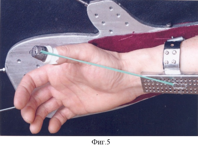 Устройство для восстановления функции пальцев кисти (патент 2324465)