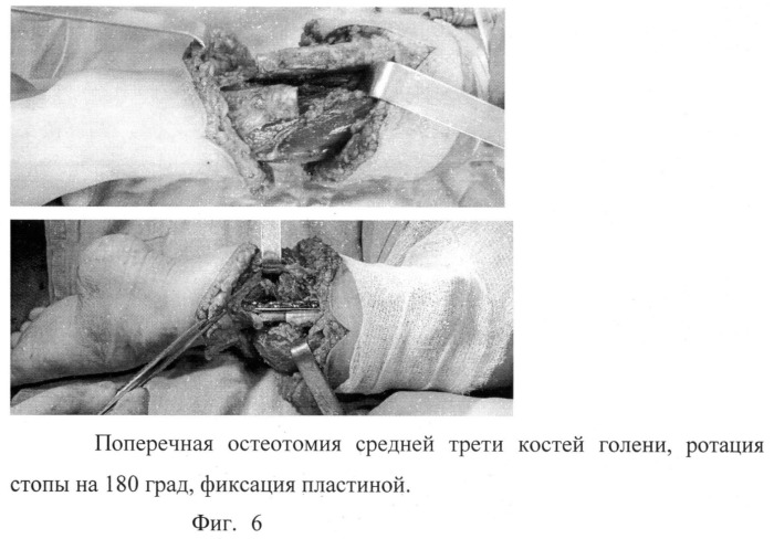 Способ ротационной остеопластики при проксимальных эктромелиях бедра (патент 2519381)