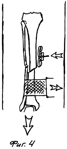 Устройство для репозиции отломков большеберцовой кости (патент 2266074)