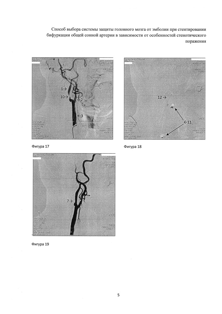 Способ выбора системы защиты головного мозга от эмболии при стентировании бифуркации общей сонной артерии в зависимости от особенностей стенотического поражения (патент 2609206)