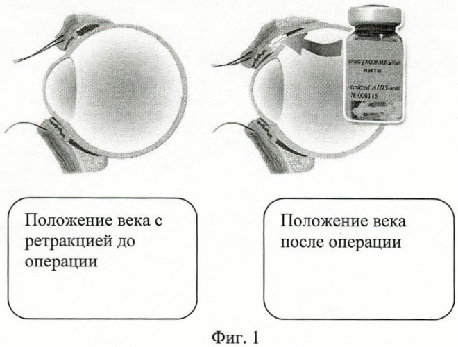 Способ устранения ретракции верхнего века при эндокринной офтальмопатии (патент 2442552)