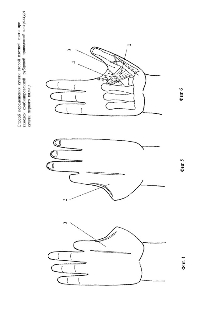 Способ перемещения культи второй пястной кости при тяжелой комбинированной рубцовой приводящей контрактуре культи первого пальца (патент 2662649)