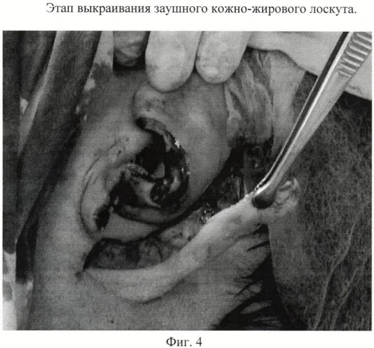 Способ пластики завитка и мочки ушной раковины (патент 2445006)