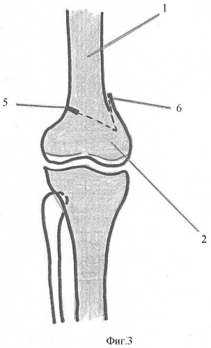 Способ устранения вальгусной (варусной) деформации бедренной кости (патент 2347540)