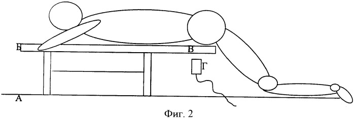 Устройство для пункции межпозвонковых дисков поясничного отдела позвоночника (патент 2395262)