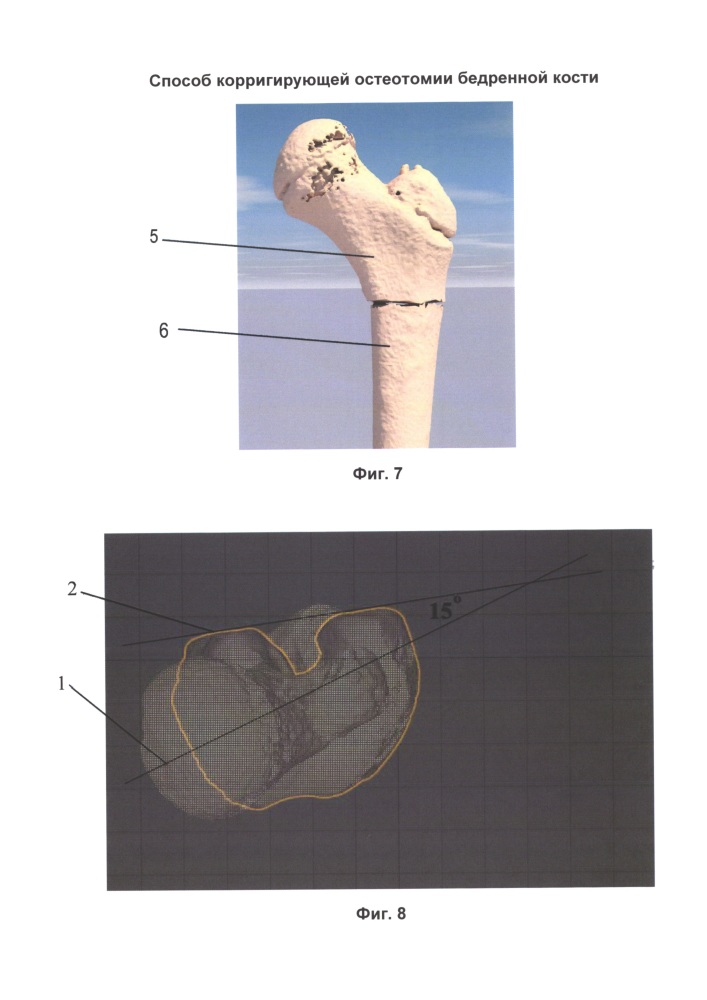 Способ корригирующей остеотомии бедренной кости (патент 2656018)