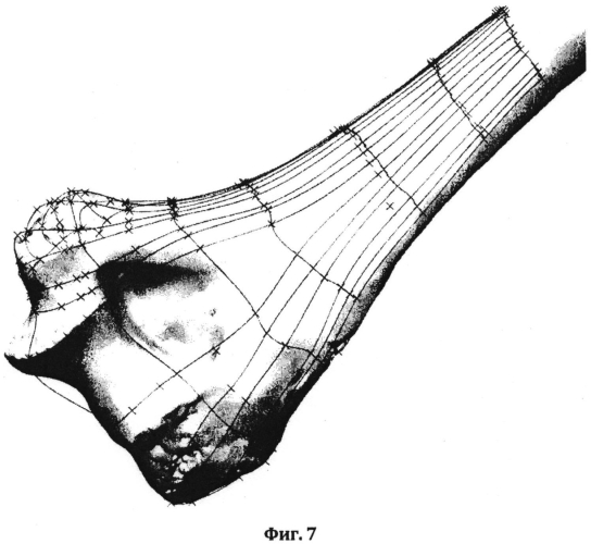 Способ проектирования индивидуальных имплантатов для остеосинтеза переломов длинных трубчатых костей (патент 2551304)
