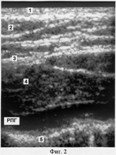 Способ ультразвукового исследования рубцового склероза мышц передней брюшной стенки (патент 2267292)