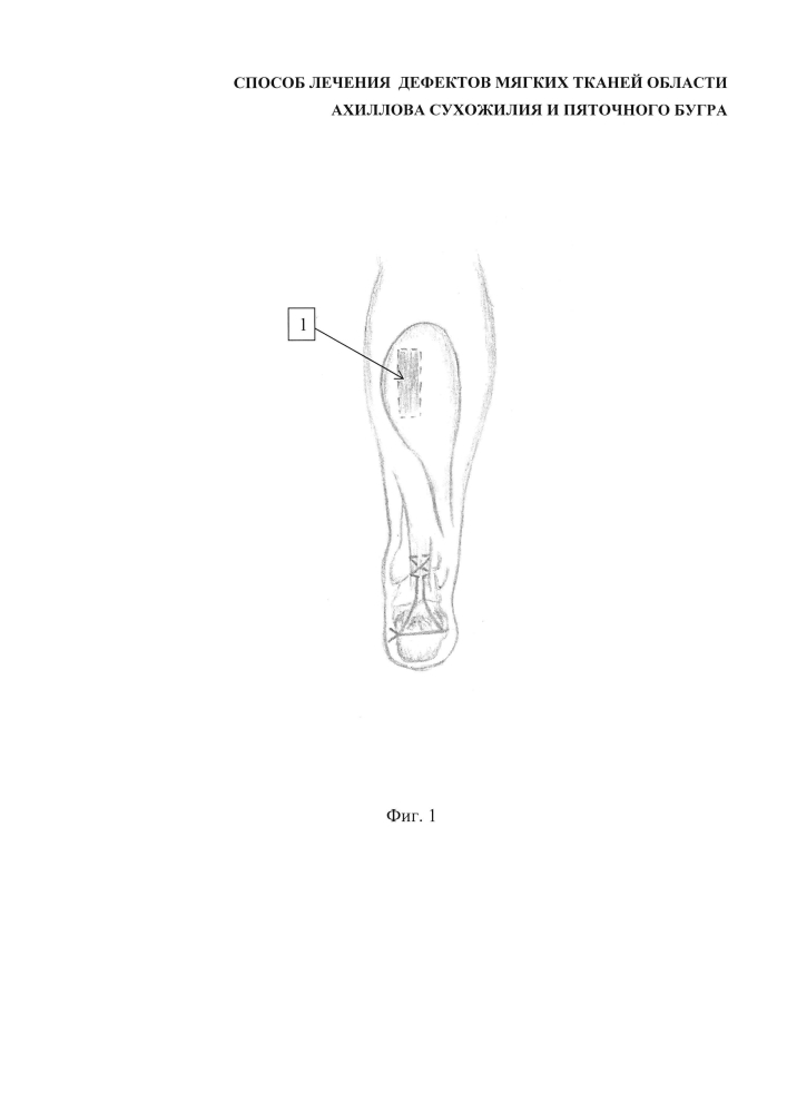 Способ лечения дефектов мягких тканей области ахиллова сухожилия и пяточного бугра (патент 2601859)