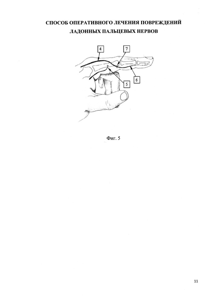 Способ оперативного лечения повреждений ладонных пальцевых нервов (патент 2612122)
