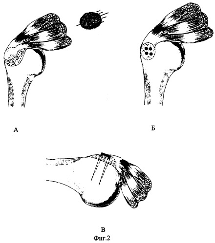 Способ хирургического лечения чрескостных разрывов сухожилий ротаторных мышц плеча (патент 2244522)