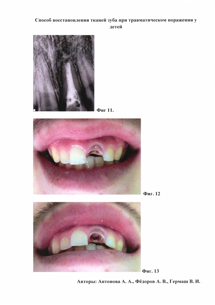 Способ восстановления тканей зуба при травматическом поражении у детей (патент 2604387)