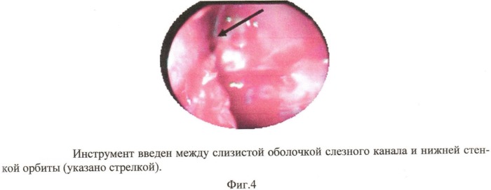 Способ хирургического лечения хронического дакриоцистита (патент 2532014)