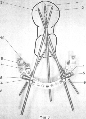Способ лечения нестабильных оскольчатых внесуставных переломов проксимального отдела бедренной кости (патент 2361535)