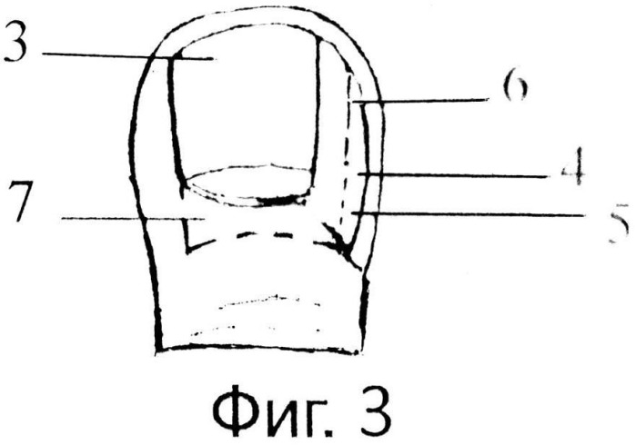 Способ лечения вросшего ногтя с использованием аппарата "сургитрон" (патент 2537782)