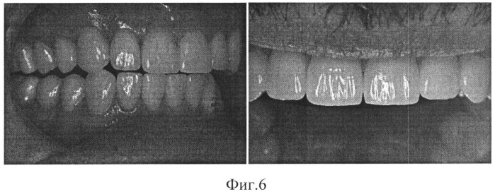 Способ эстетической реставрации зубов (патент 2529398)