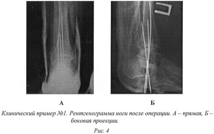 Способ послеоперационного лечения больных с открытой травмой голеностопного сустава (патент 2368339)