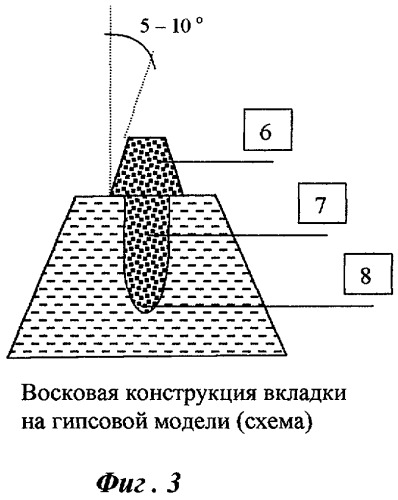 Способ изготовления цельнолитой культевой штифтовой вкладки (патент 2252728)