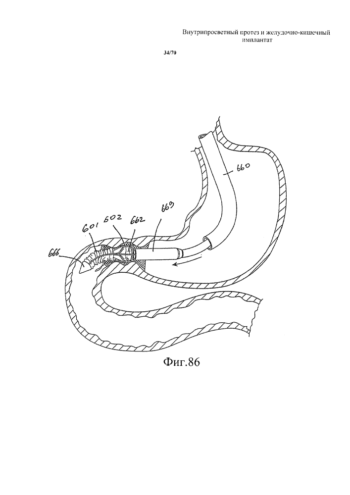 Внутрипросветный протез и желудочно-кишечный имплантат (патент 2626885)