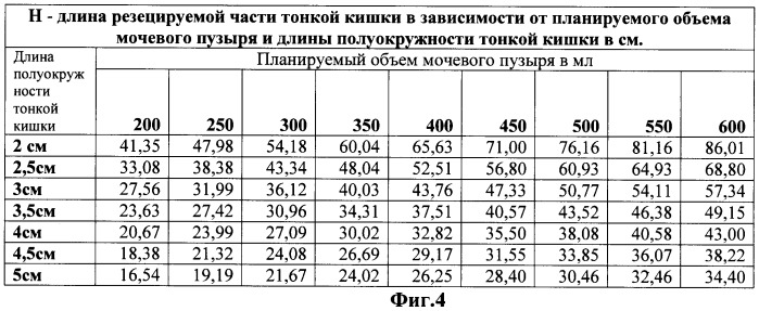 Способ определения длины резецируемой части тонкой кишки для пластики мочевого пузыря (патент 2444307)