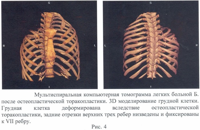 Способ лечения деструктивного туберкулеза легких (патент 2475192)