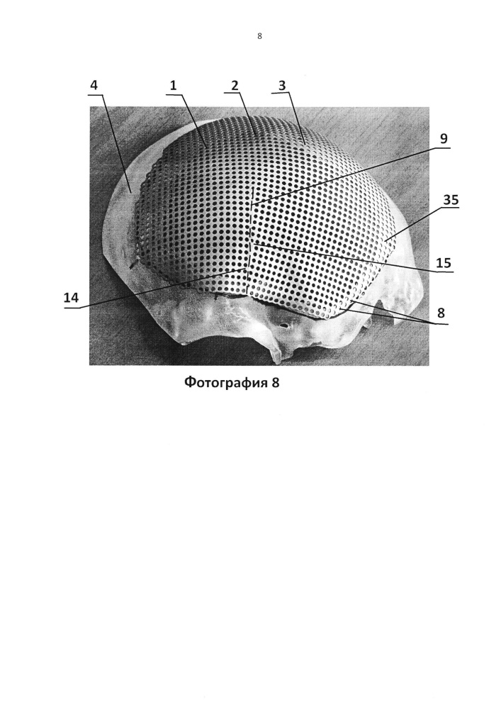 Имплантат для протезирования костей черепа и способ изготовления имплантата для протезирования костей черепа (патент 2638894)