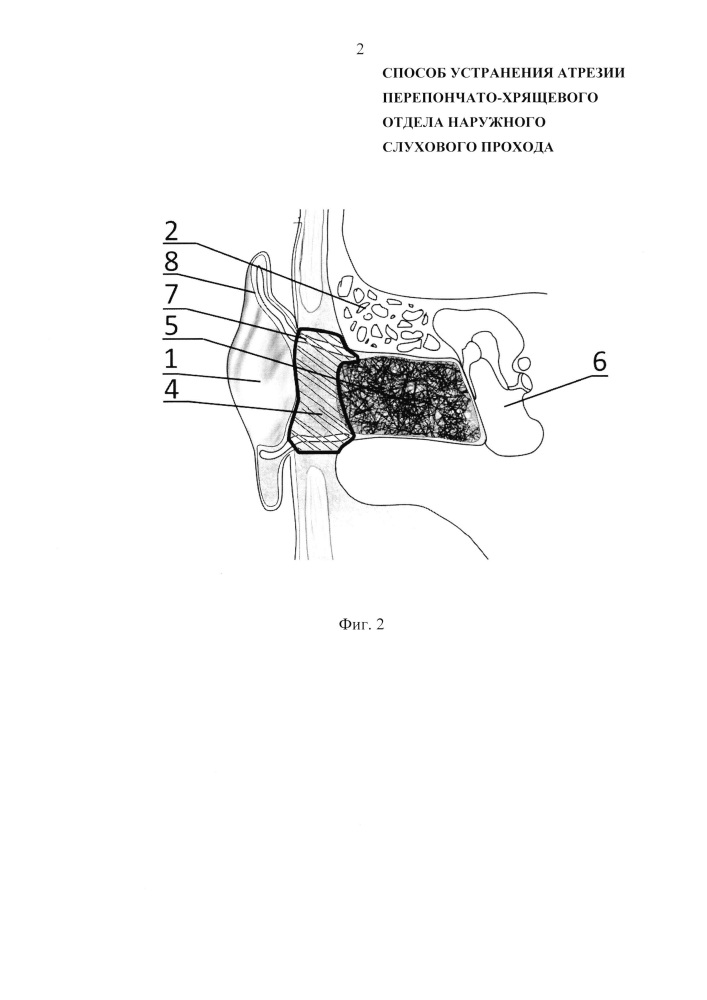 Способ устранения атрезии перепончато-хрящевого отдела наружного слухового прохода (патент 2621948)