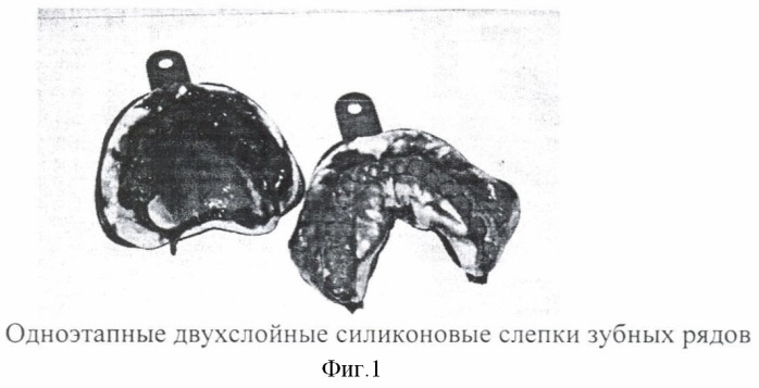 Способ воспроизведения зарегистрированных окклюзионных положений на компьютерных трехмерных моделях зубных рядов и ориентации компьютерных трехмерных моделей в пространстве (патент 2401083)