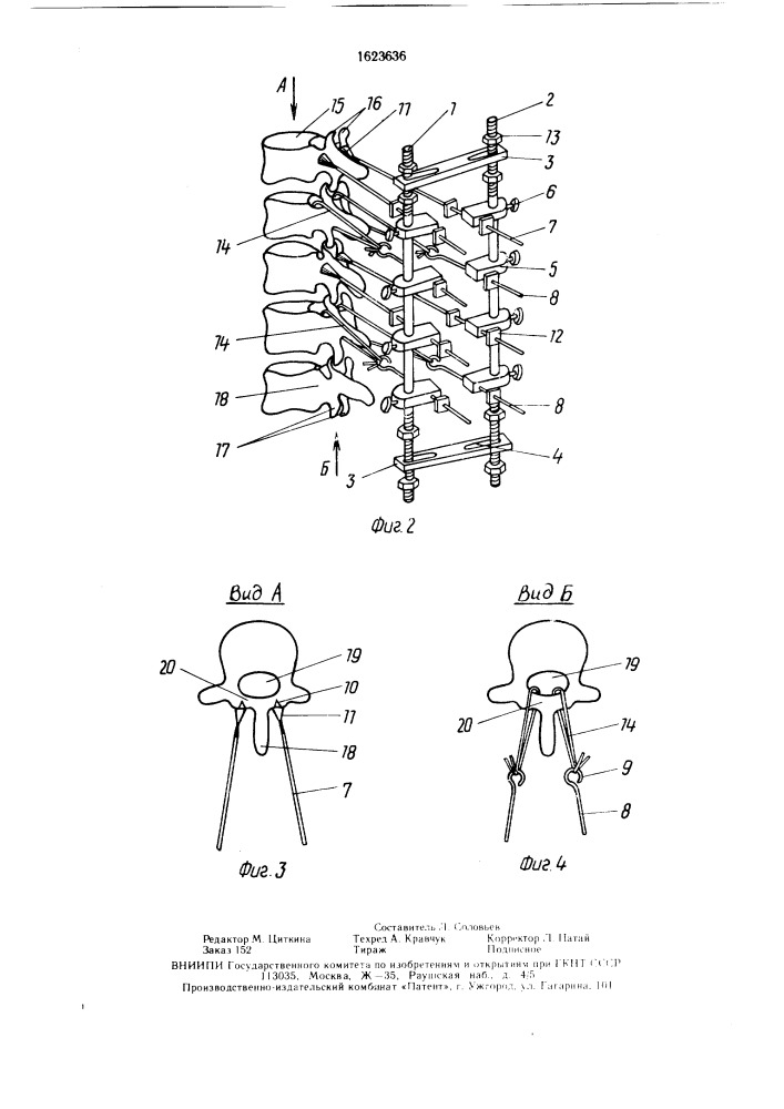 Устройство для вправления и фиксации позвонков (патент 1623636)