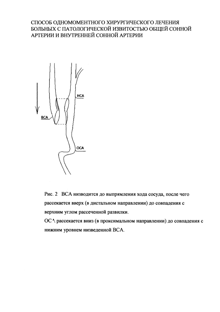 Способ одномоментного хирургического лечения больных с патологической извитостью общей сонной артерии и внутренней сонной артерии (патент 2618209)