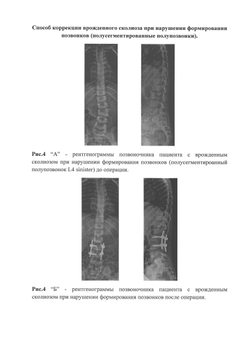 Способ коррекции врожденной сколиотической деформации позвоночника при полусегментированном полупозвонке у детей (патент 2578097)