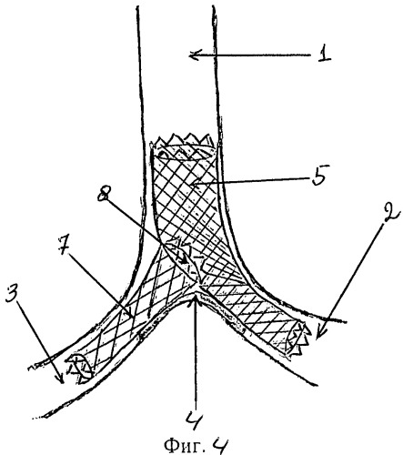Способ стентирования бифуркации трахеи (патент 2465850)