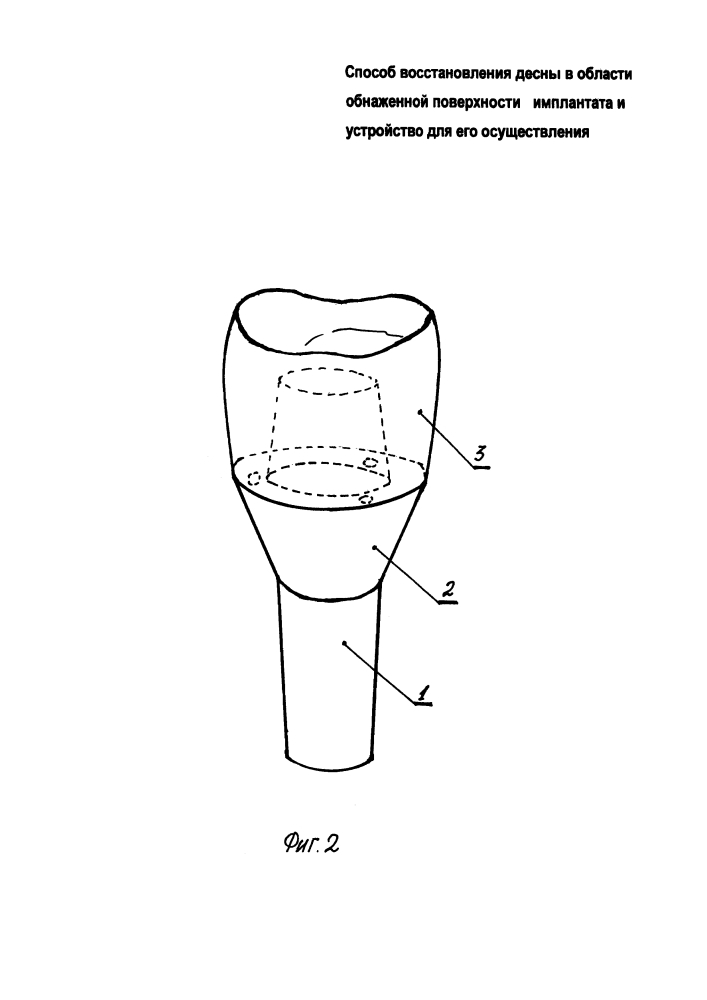 Способ восстановления десны в области обнаженной поверхности имплантата и устройство для его осуществления (патент 2597145)