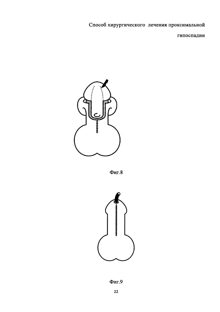 Способ хирургического лечения проксимальной гипоспадии (патент 2665545)
