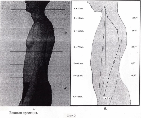 Способ цифровой диагностики деформаций позвоночника (патент 2392855)