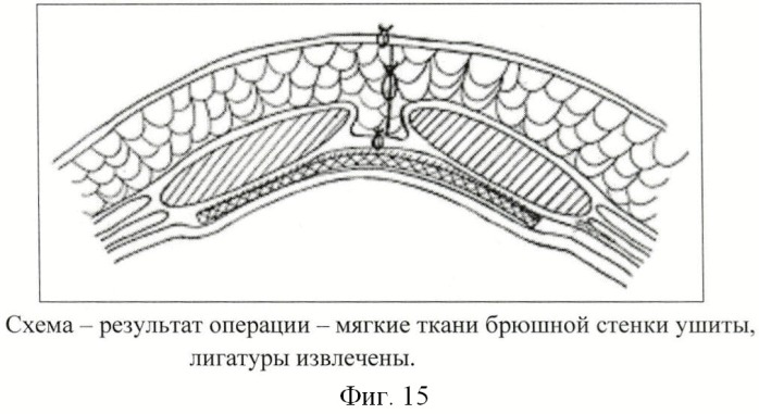 Способ размещения имплантата (патент 2445011)