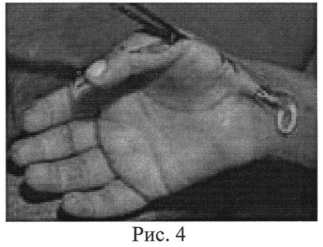 Способ устранения сгибательно-приводящей контрактуры первого пальца кисти у больных с детским церебральным параличом (патент 2537772)