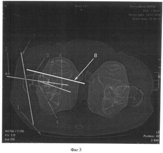 Способ оценки положения проксимального отдела бедренной кости (патент 2493774)