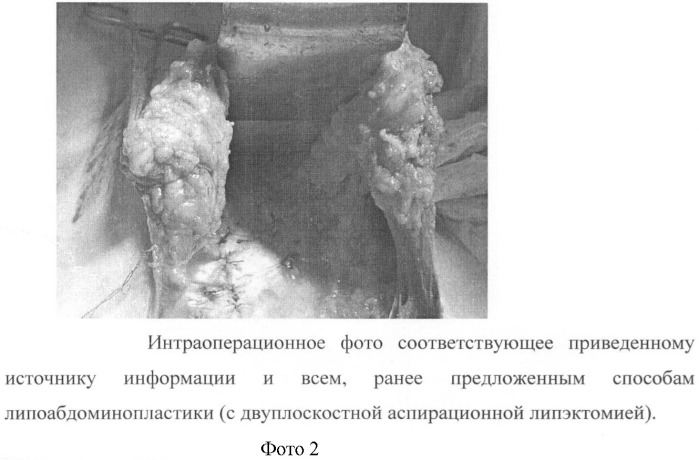 Способ липоабдоминопластики (патент 2410043)