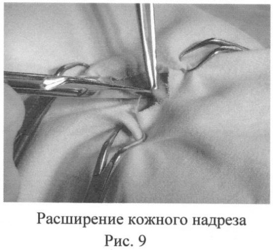 Способ овариогистерэктомии кошек по боковому доступу (патент 2396923)