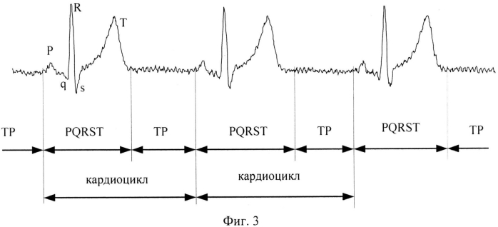 Способ адаптивной фильтрации электрокардиосигнала (патент 2568817)