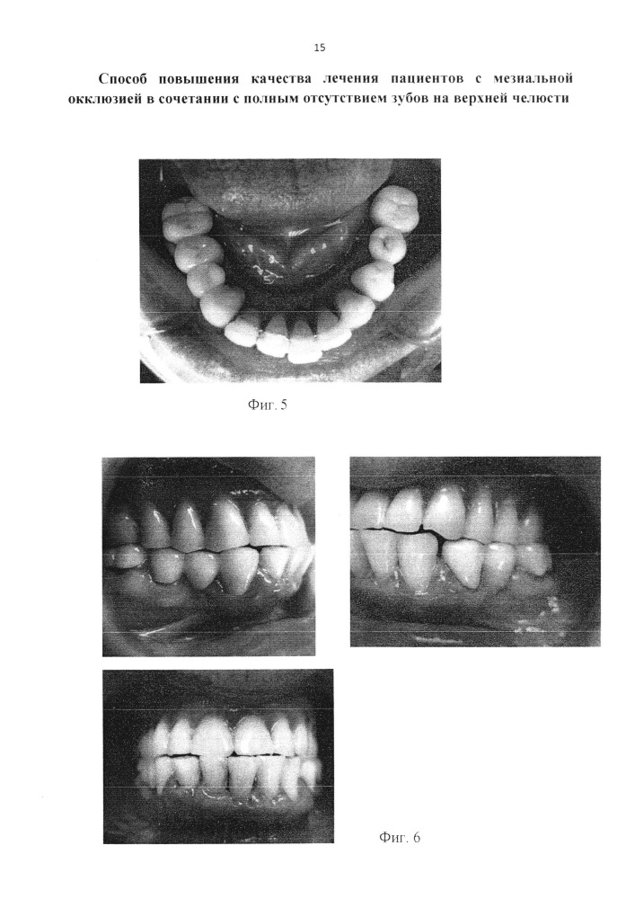 Способ повышения качества лечения пациентов с мезиальной окклюзией в сочетании с полным отсутствием зубов на верхней челюсти (патент 2658159)
