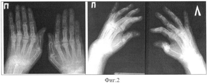 Способ реконструкции деформаций кисти при ревматоидном артрите (патент 2452422)