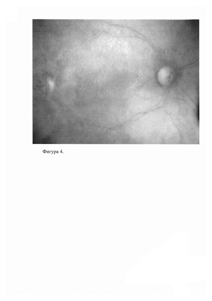 Способ определения посттравматических изменений глазного дна и уточнения тяжести поражения (патент 2624374)