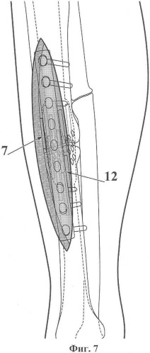 Способ хирургического лечения ложных суставов трубчатых костей конечностей (патент 2349279)